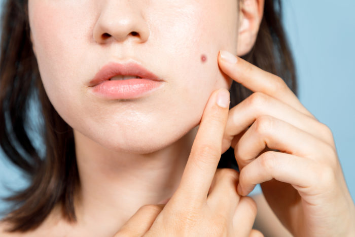 acne op een droge huid