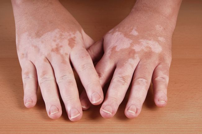 vitiligo kan genezen