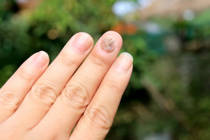 schimmelinfectie van de nagel