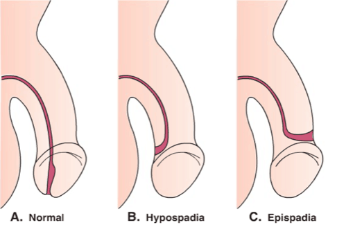 het penisgat is niet normaal, episoden van hypospadie