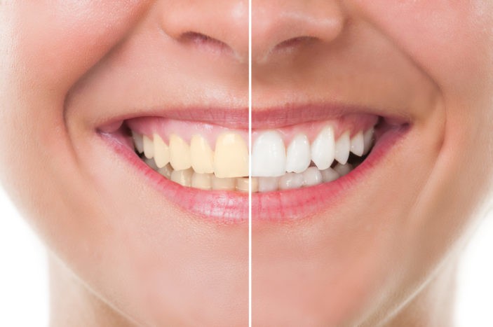Bijwerkingen van tanden bleken met bleken