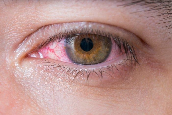 allergische rode ogen conjunctivitis