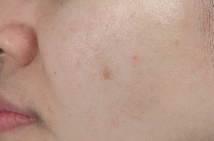 hoe zich te ontdoen van acne littekens zwarte vlekken