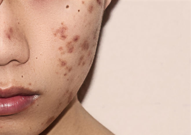 Castorolie ricinusolie verwijdert acne littekens
