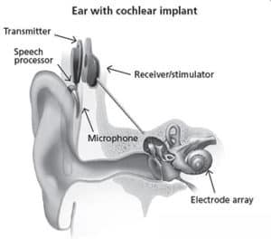 cochleair implantaatapparaat