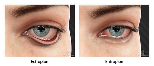 ectropion van ooglidafwijkingen