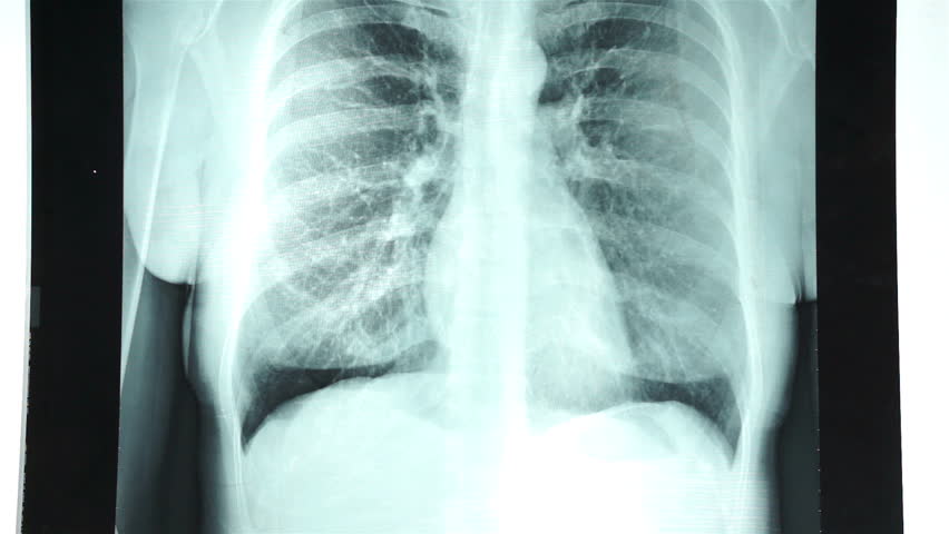 borst röntgenfoto