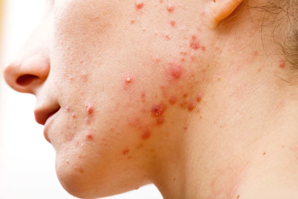 clindamycine ontstoken acne medicatie