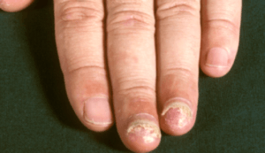 broze nagels