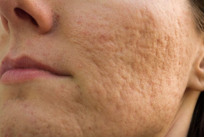 hoe zich te ontdoen van pokdalige acne littekens