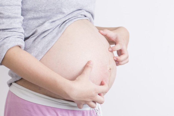 Pruritische folliculitis is de oorzaak van jeukende huid tijdens de zwangerschap